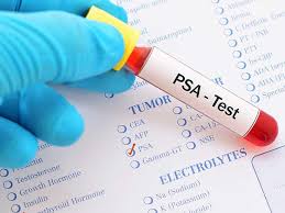 PSA (prostate specific antigen) test